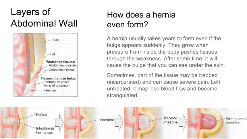 Que es peor hernia o protrusión